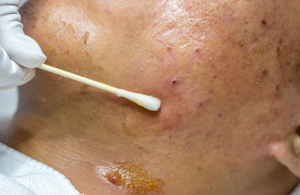 การรักษาสิวสไตล์ M Vita Clinic